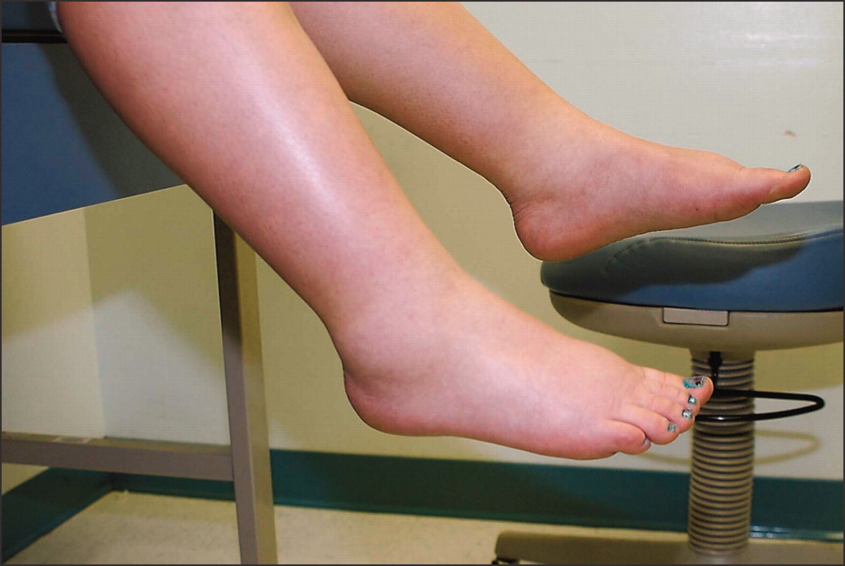 Kodėl hipertenzija kojos tinsta?