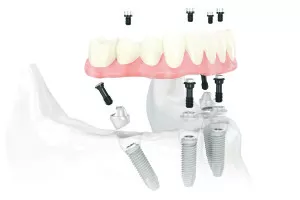 Klinikoje „Dantų harmonija“ naudojama gydymo metodika leidžia atkurti vieno žandikaulio dantis per vieną dieną.