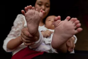 YUEYANG, CHINA - MAY 01: (CHINA OUT) Mother shows 3-month-old baby boy's feet with 16 toes at Zhongping village on May 1, 2016 in Pingjiang County, Yueyang City, Hunan Province of China. Hong Hong was a 3-month-old baby boy who was born with 15 fingers and 16 toes. He had two palms on each hand with 7 fingers on right hand and 8 fingers on left hand. He also had 8 toes on each foot. Hong Hong's mother had 6 fingers on each of her hand and 6 toes on each of her foot. Doctor of Hunan Province People's Hospital told Hong's father that his son had better take an operation since six month old to 1 year old. ©Exclusivepix media