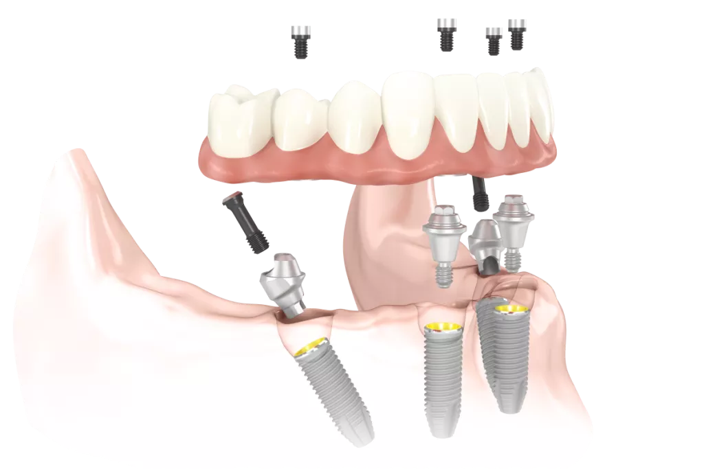 „All-on-4®“ (lietuviškai „visi ant 4“) gydymo metodas – kai visi vieno žandikaulio dantys yra atkuriami vos ant keturių implantų.
